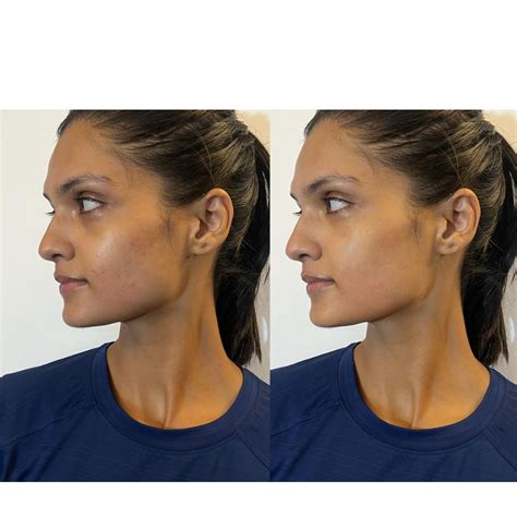 nose yoga before and after.